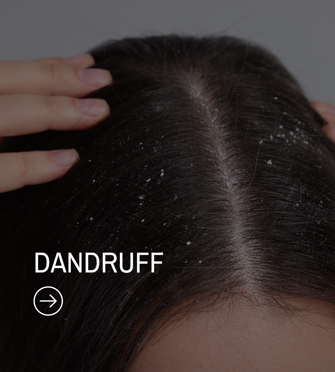 Dandruff